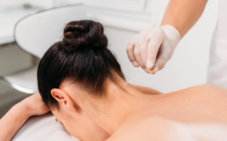 Femme en séance d'acupuncture avec des aiguilles dans le cou