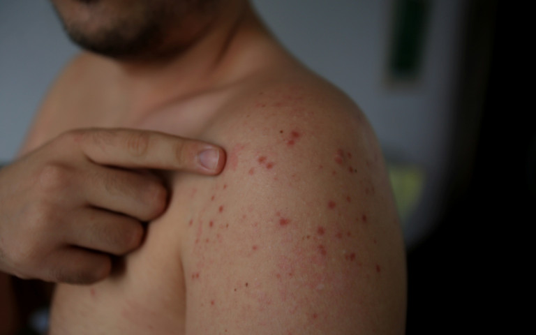 man met rode huiduitslag
