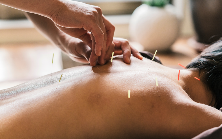 Acupunctuurbehandeling rug
