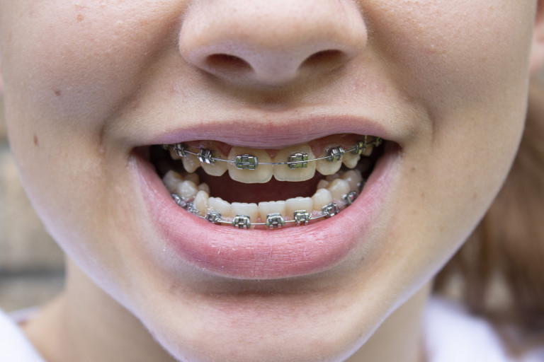 Jong meisje met blokjes op de tanden